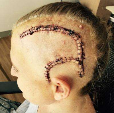 Tim’s wife Tara after her 2nd round of brain surgery